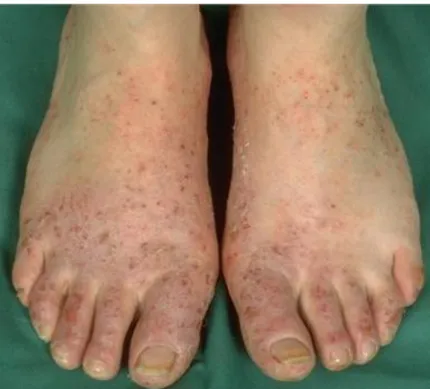 Figure 13 : Eczéma dysidrosique des pieds [16] 