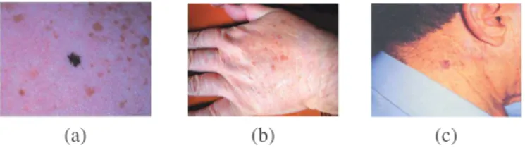 Fig. 1: Lentigo simplex (a), Solar lentigo (b) and Lentigo maligna (c).