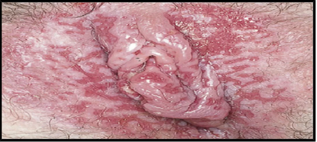 Figure   7  :  Vulvo-vaginite herpétique aiguë montrant des érosions confluentes de la muqueuse vulvaire[37].
