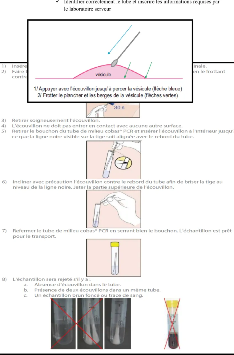 Figure   12    :Prélèvement d’une lésions suspecte d’HSV en vue de la confirmation[52].