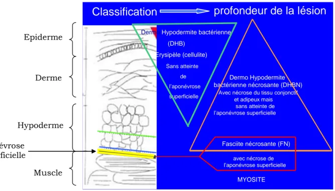 Fig. 2. Classification des IPM en fonction de la profondeur de la lésion, service de  microbiologie, HMIMV, Rabat