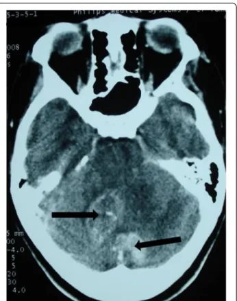 Figure 1 Cerebral computed tomography scan of two lesions in the right cerebellar hemisphere and the vermis (arrow)