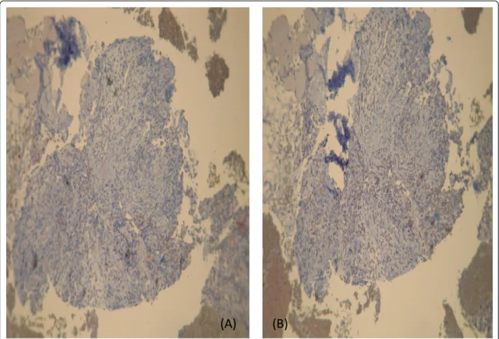 Figure 7 Immunohistochemistry shows that the tumor cells are negative for CD-117 (A) and CD-34 (B)