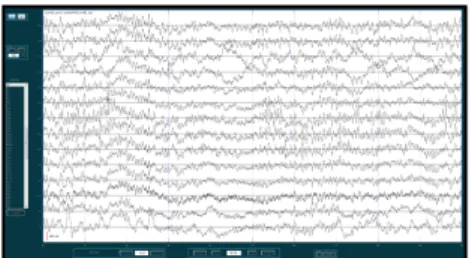 Figure 1: Classical representation as a line graph of an EEG signal. Each line represents a channel from an intracerebral recording.