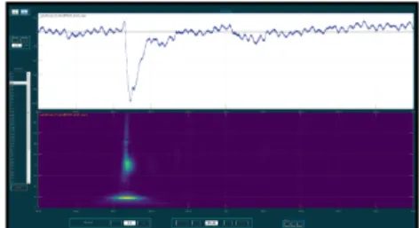 Figure 4: Example of an interictal epileptic spike (IES) in a one second time window. Top: raw signal, bottom:  time-frequency representation.