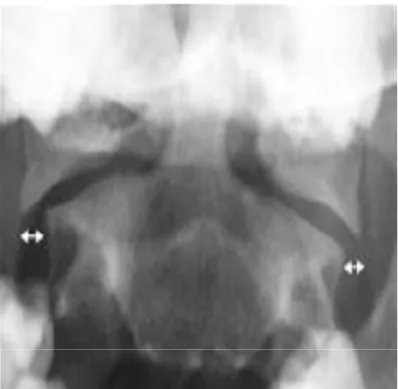 Figure 16. Fracture de Jefferson ( fracture-luxation divergente des    masses articulaires de  l’atlas )