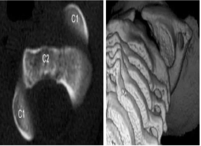 Figure 18. Luxation rotatoire atlanto-axoidienne de type 1. Notez la luxation complète des  masses latérales de C1 par rapport a C2 en coupe axiale (A) et sur la reconstruction 3D (vue 