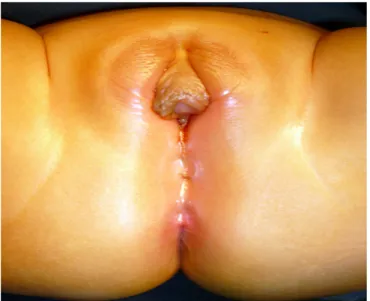 Figure 5 : Aspect des organes génitaux externes chez une enfant avec HCS 