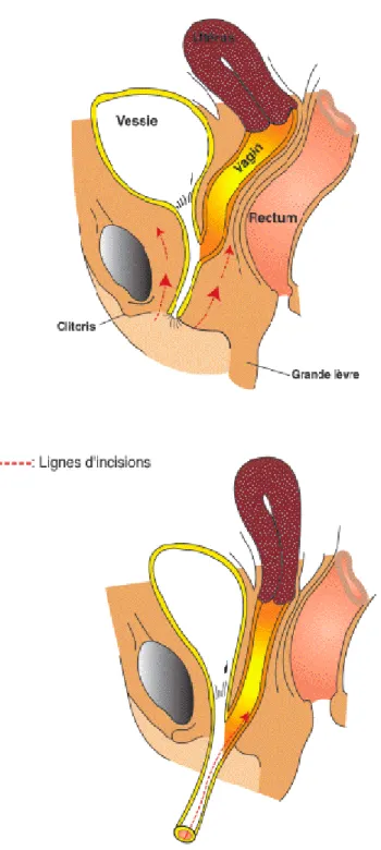Figure 9 :Mobilisation complète du sinus uro-génital 