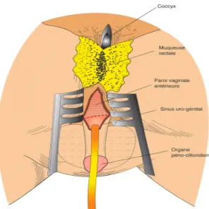 Figure 12 : Approche sagittale postérieure des sinus uro-génitaux 