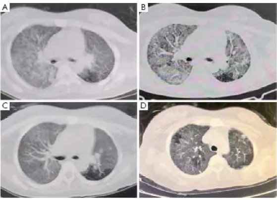Figure 11 : Scanner thoracique chez une des patientes dans l’étude de Zhu et al, et son  évolution sous traitement [93] 