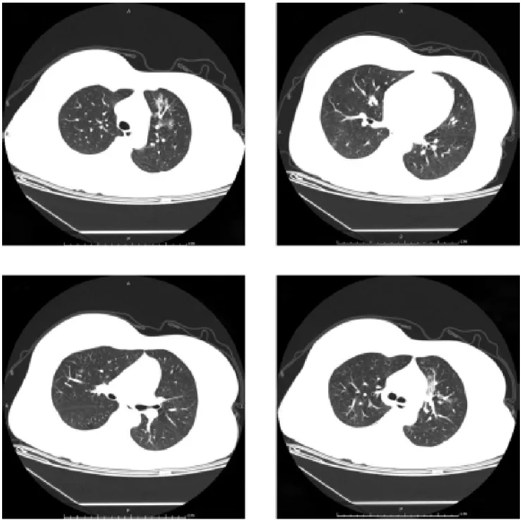 Figure 12 : Scanner thoracique du cas rapporté par Wang et al [94] 