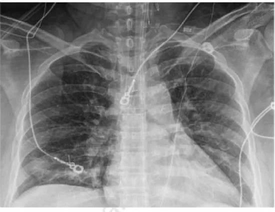Figure 13 : Radiographie thoracique chez une patiente atteinte de la Covid-19 [96] 