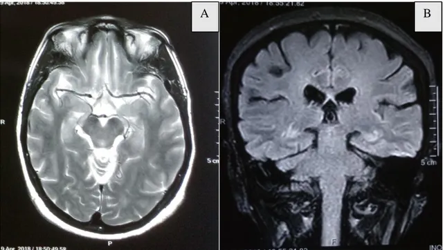 Figure 3 : IRM cérébrale en coupe axiale séquence T2  (A) et séquence flair coupe coronale (B) montre un aspect normal