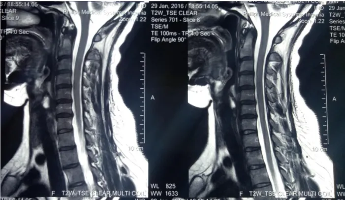 Figure 5 : IRM cervicale normale en coupe sagittale séquence T2