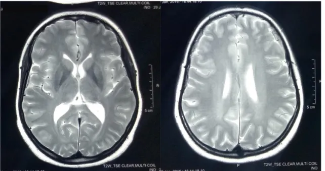 Figure  SEQ Figure \* ARABIC 8 : IRM cérébrale en coupe axiale séquence T2 normale   Figure 8 : IRM cérébrale en coupe axiale séquence T2 normale