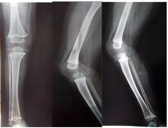 Figure 14: radiographies de la jambe droite du patient numéro 8  