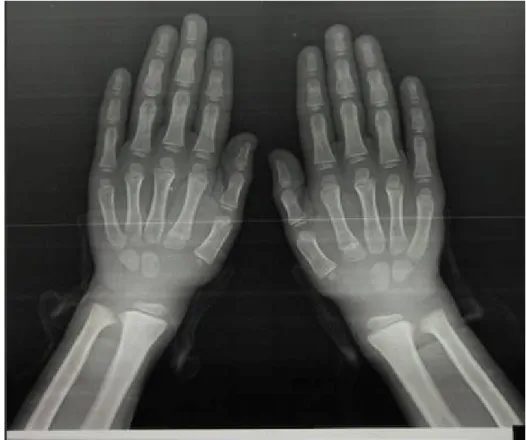 Figure 17: radiographie des 2 mains : absence de polydactylie 