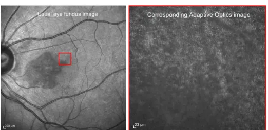 Fig. 1. Usual eye fundus image vs. Adaptive Optics image of the retina on a patholog- patholog-ical eye