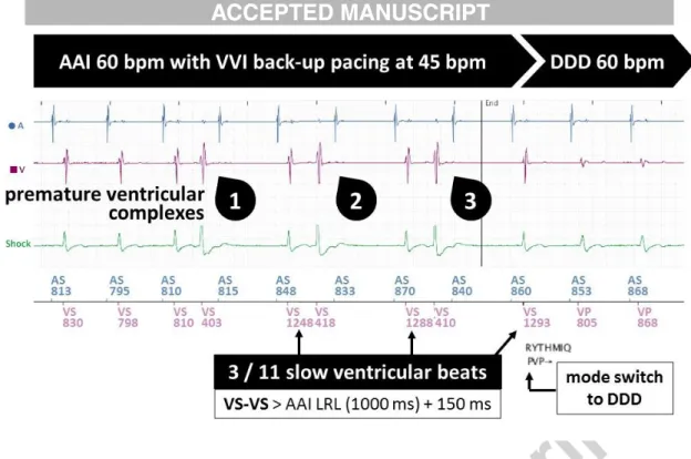 Figure 2: Example of an inappropriate RYTHMIQ TM  episode induced by premature ventricular  contractions (PVCs)