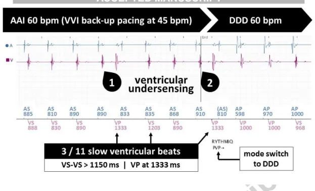 Figure 4. Example of inappropriate RYTHMIQ TM  episode unmasking ventricular undersensing