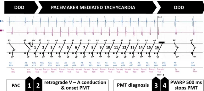 Fig. 6 shows that directly after the PVARP extension a ventricular tachycardia (VT) is initiated