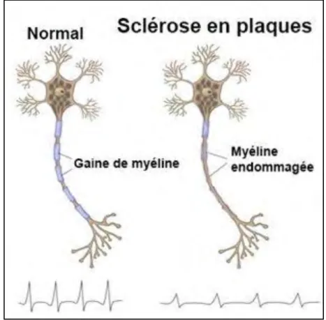 Figure 3 : Aspect de la gaine de myéline dans le cadre de la SEP (d'après http://www.docteurclic.com/maladie/sclerose- http://www.docteurclic.com/maladie/sclerose-en-plaque.aspx) 