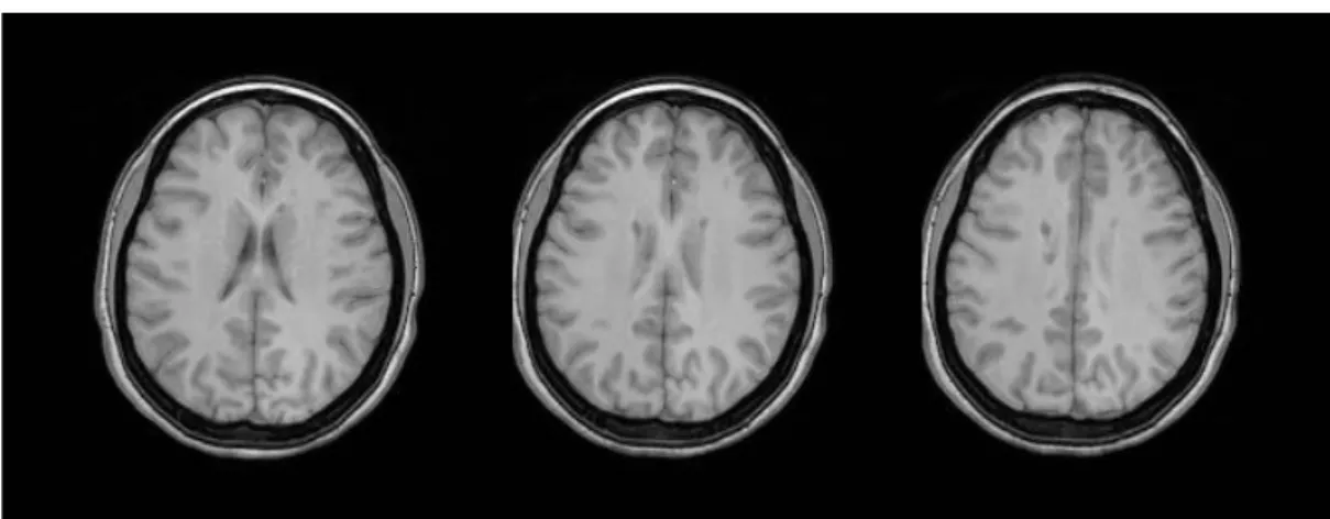 Figure 8 : Aspect des lésions en pondération T1 sans injection de produit de contraste : Iso- ou Hypo-signaux (image issue  d'acquisitions effectuées au sein du plateau IRM de l'INSERM U825) 