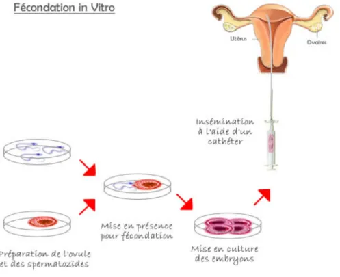 Fig 3 : La fécondation in vitro. 