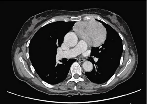 Figure 11 : Masse médiastinale antérieure diffuse, bien limitée (thymome probable) 