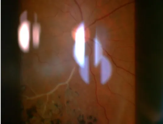 Figure 9 : Image du fond de l’œil montrant un vaisseau déshabité et des impacts de  laser en inferieur sur une ischémie rétinienne