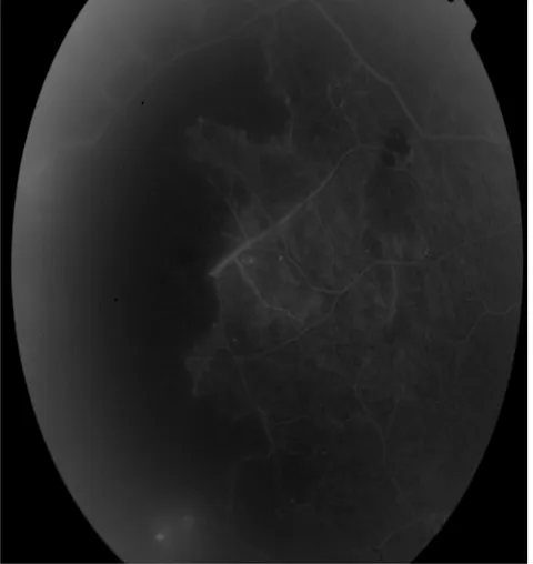 Figure 10 : photo d’une angiographie montrant une ischémie rétinienne. 