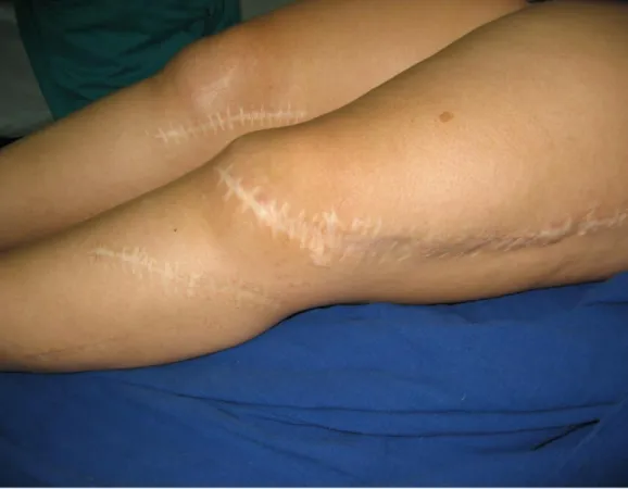 Figure  1 :   genou  cicatriciel  avec  une  cicatrice  antéro-externe  au  niveau  de  la  cuisse  et  dérotant  sur  la  région  patellaire  et  une  cicatrice  antéro-externe  au  niveau  de  la  métaphyse  tibiale supérieure et une cicatrice en regard 