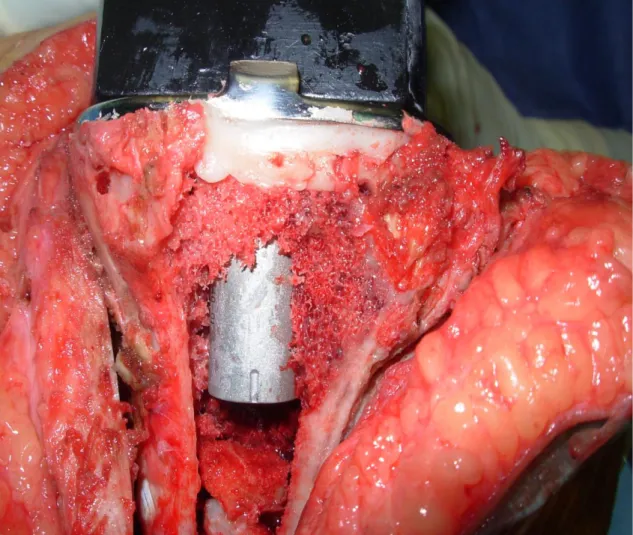 Figure 3b :  vue opératoire montrant l’implant tibial posé avec baguette tibiale relevée