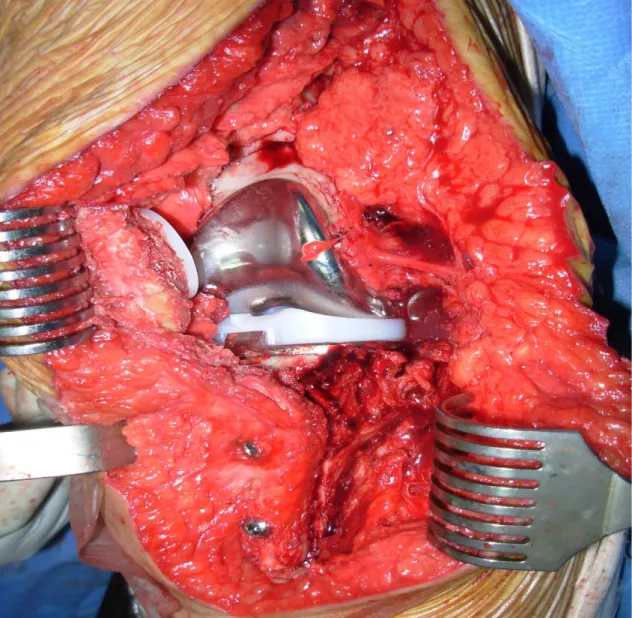 Figure 3c :  vue opératoire montrant l’implant fémoral puis rotulien posé après remise de  la baguette tibiale à sa place en la remontant d’un cm et fixant par deux vis
