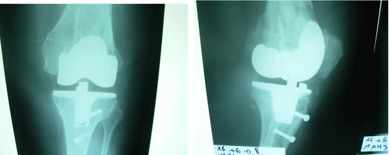 Figure  4  a  et  b :  radiographies  objectivant  le  bon  positionnement  de  la  prothèse,  la  consolidation  du  relèvement  de  la  baguette  tibiale,  la  relative  ascension  de  la  rotule  et  la  décalcification du tendon rotulien.