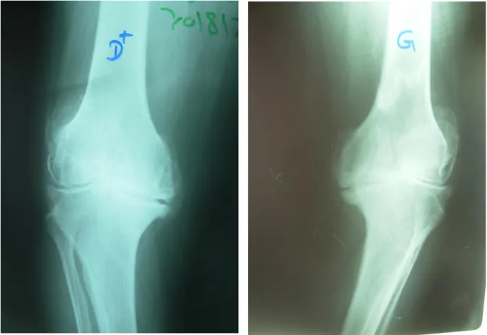 Figure 6 :  radiographies de face du genou droit et gauche montrant la gonarthrose fémoro- fémoro-tibiale avec destruction des condyles fémoraux