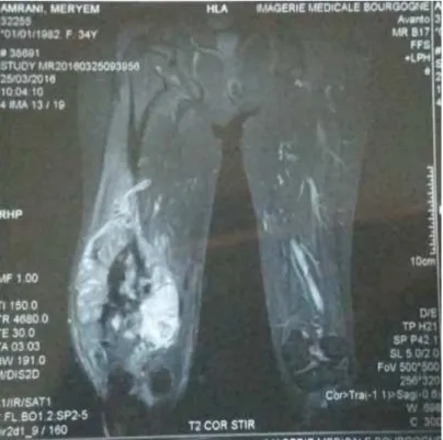 Figure 9: IRM du genou droit. 