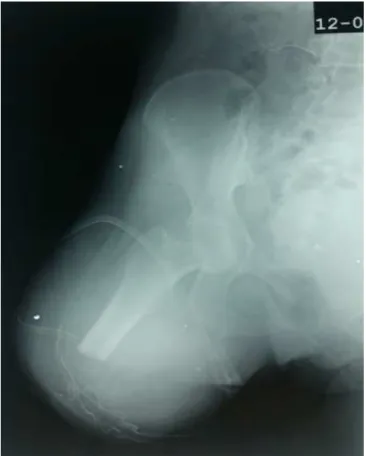 Figure 10: Rx de la hanche gauche après amputation. 