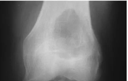 Figure 3 : kyste anévrysmal du fémur distal 
