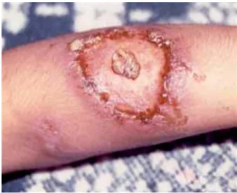 Figure 6 : Lésion ulcéreuse de pyoderma gangrenosum   sur l’avant-bras droit [1] 