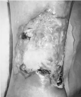Figure 8 : PG ulcéreux : ulcération à bordure irrégulière  et à fond mucopurulent [5]