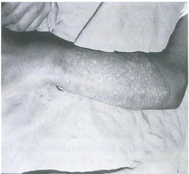Figure 3 :   Cicatrice cribriforme de l’avant bras [184]. 