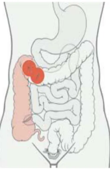 Figure 3montrant la colostomie transverse  [6] 