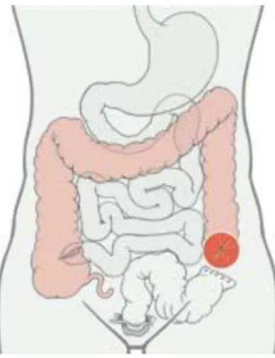 Figure 4 montrant une  sigmoïdostomie  [6]  . 