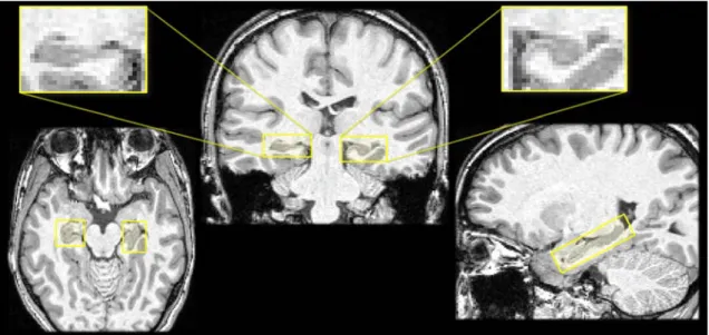 Figure 2.10: Two visualizations of hippocampus of a same subject from the IRMA7 database