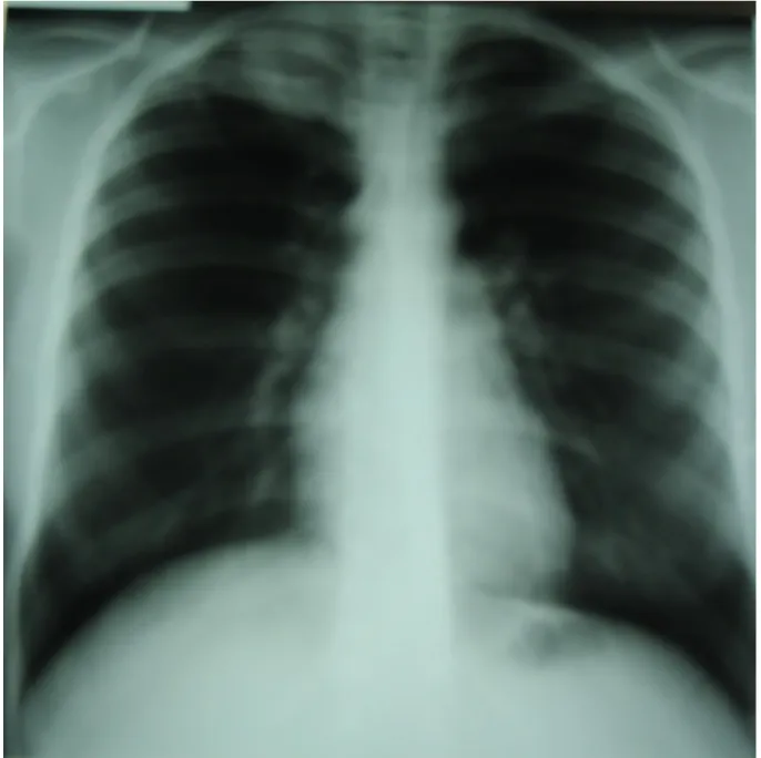 Figure 3 : Tuberculose pulmonaire peu étendue. 