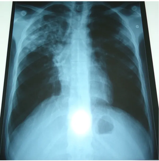 Figure 4 : Tuberculose pulmonaire multi-excavée, étendue et bilatérale. 