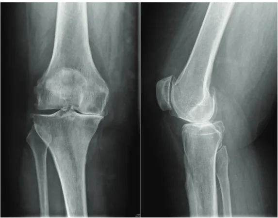 Fig. 5. The radiography of an osteoarthritic knee  