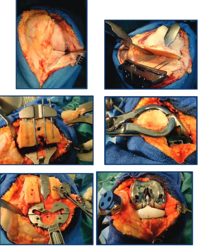 Fig. 18  The surgical technique of our center of implantation of total knee arthroplasty [82] 